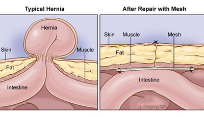 What is Hernia?