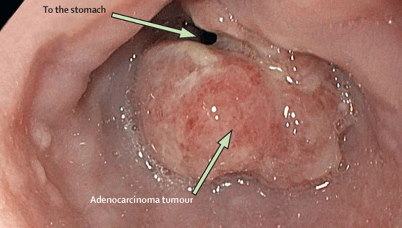 Carcinoid Tumours