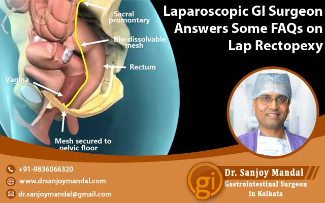 Laparoscopic GI Surgeon Answers Some FAQs on Lap Rectopexy