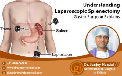 Understanding Laparoscopic Splenectomy – Gastro Surgeon Explains