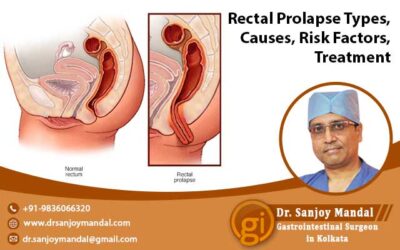 Rectal Prolapse Types, Causes, Risk Factors, Treatment