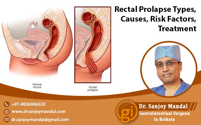 Rectal Prolapse Types, Causes, Risk Factors, Treatment
