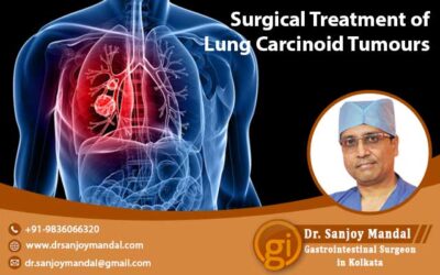 Surgical Treatment of Lung Carcinoid Tumours