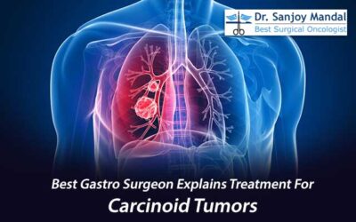 Best Gastro Surgeon Explains Treatment For Carcinoid Tumours