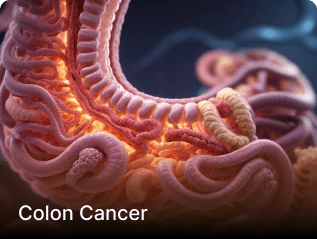 Colon Cancer
