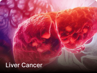 Liver Cancer