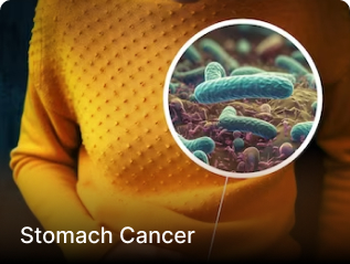 Stomach Cancer