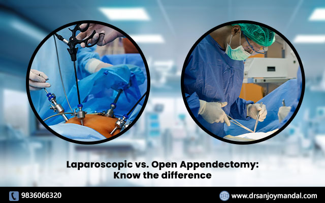 Laparoscopic vs. Open Appendectomy: Know the Difference