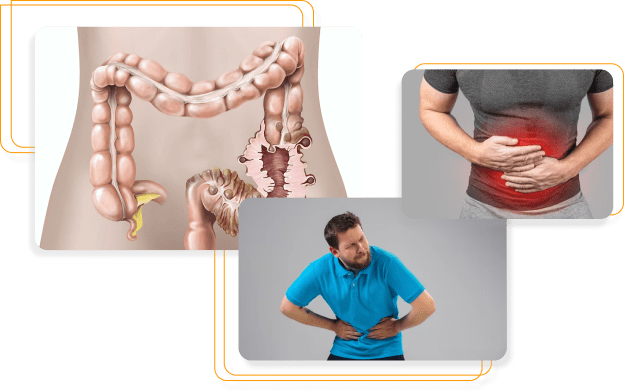 Diverticular Disease Of Large Bowel