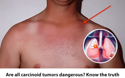Are all carcinoid tumors dangerous? Know the truth