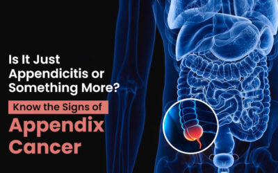 Is It Just Appendicitis or Something More? Know the Signs of Appendix Cancer