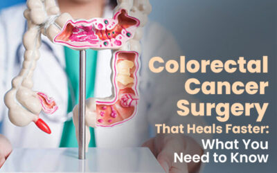 Colorectal Cancer Surgery That Heals Faster: What You Need to Know