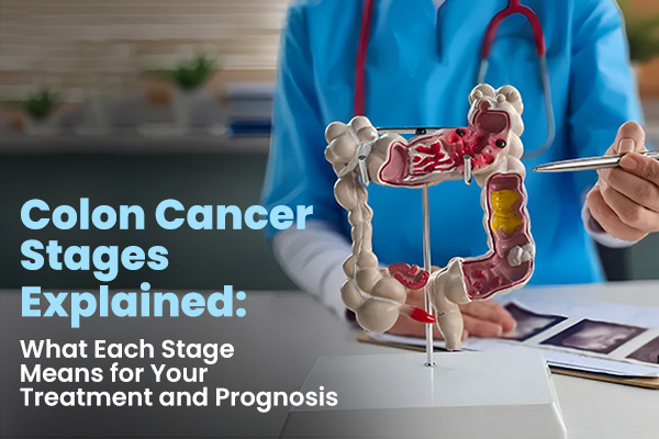 Colon Cancer Stages Explained: What Each Stage Means for Your Treatment and Prognosis