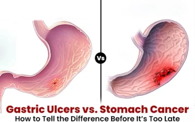 Gastric Ulcers vs. Stomach Cancer: How to Tell the Difference Before It’s Too Late