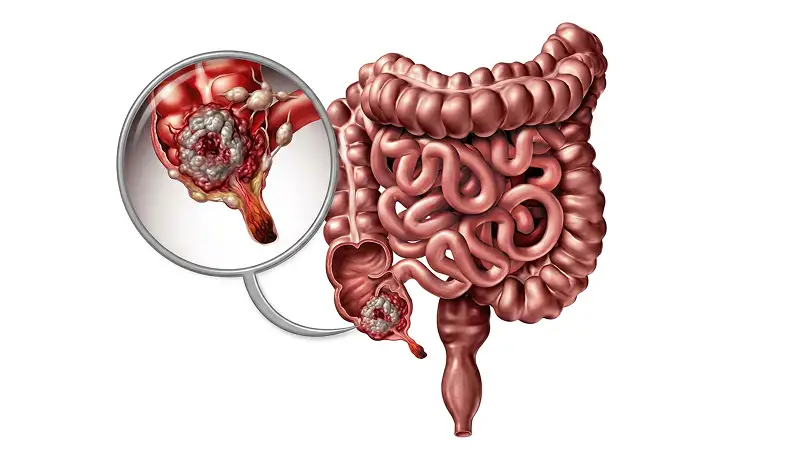 Appendicular Cancers