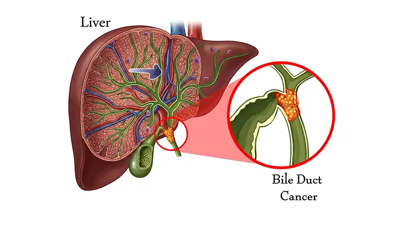 Bile Duct Cancer