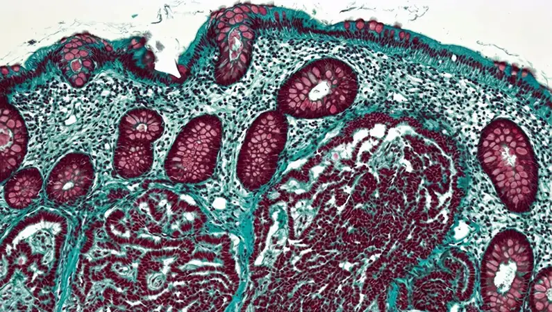 Neuroendocrine Tumours