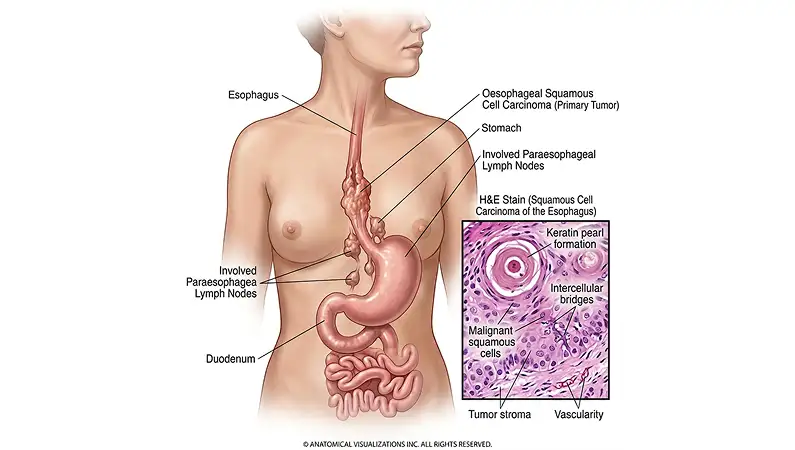 Oesophageal Cancer