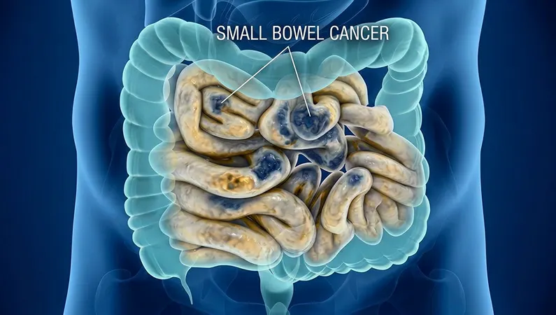 Small Bowel Cancer